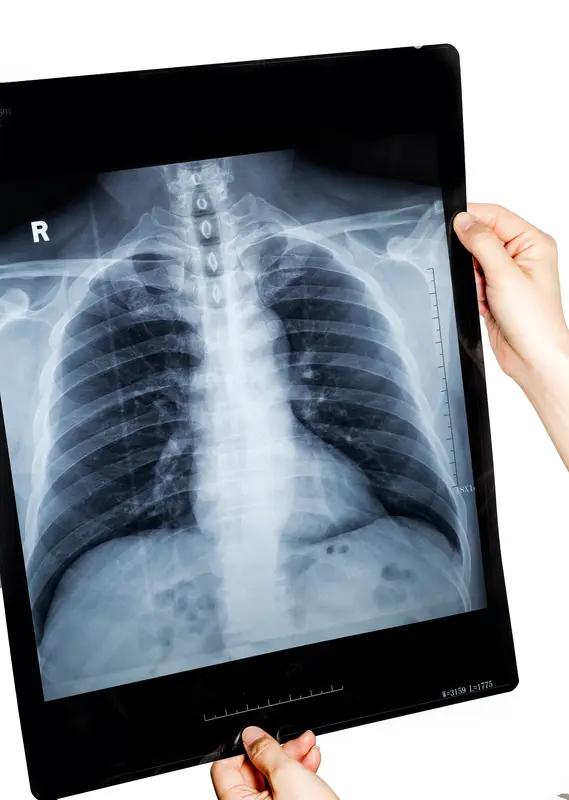 中老年体检，选对项目很重要，它们就是健康“守门人”。胸部CT平扫（薄层扫描）得