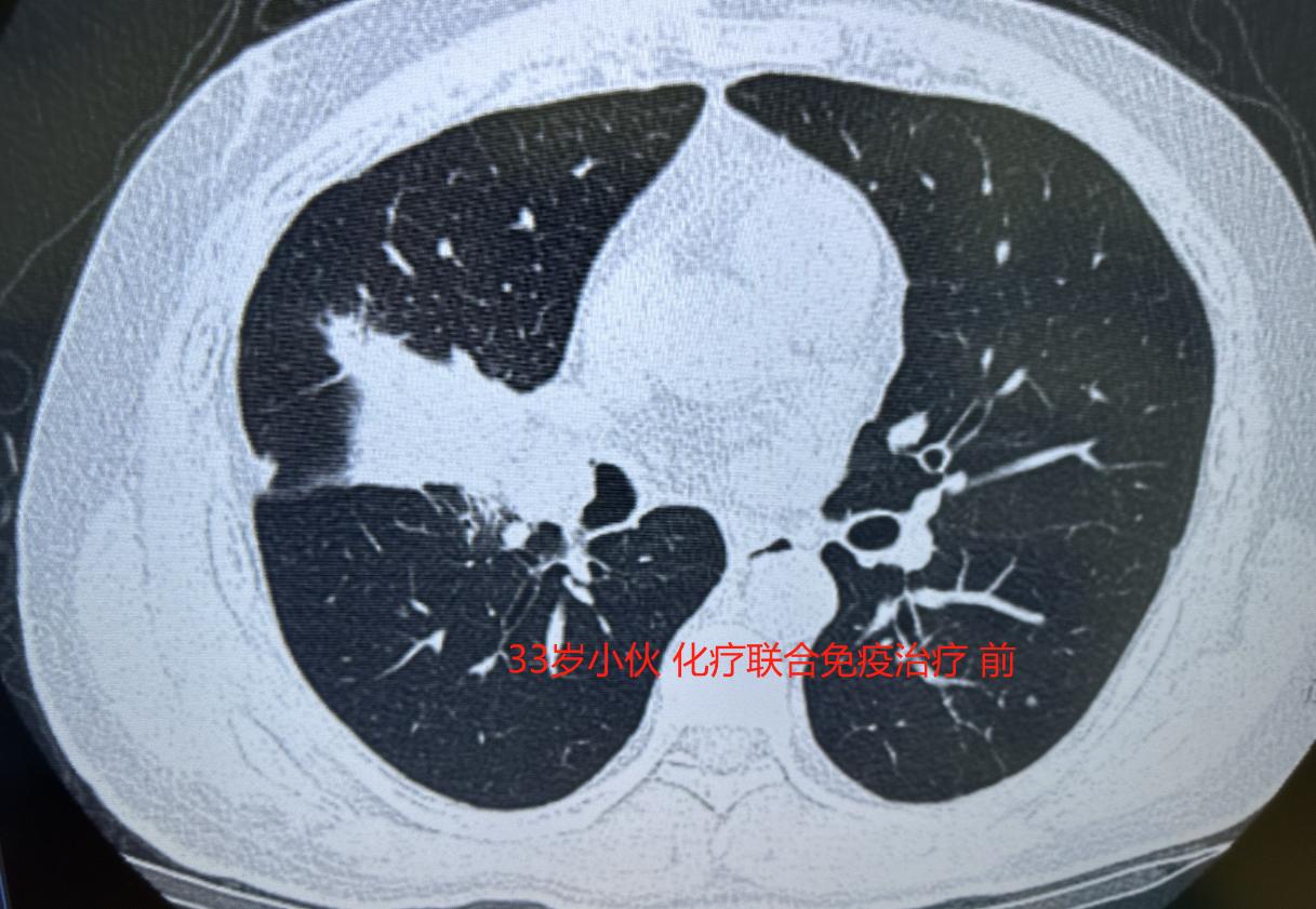 33岁的年轻人，因为咳嗽得厉害去检查，发现右肺中叶长了一个很大的肿瘤，进一步检查