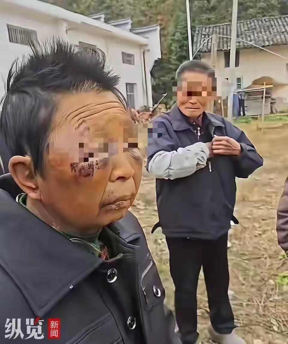 妇女多次被丈夫家暴，出院后又被打，现在脸上多处淤青，又送进医院。据网友爆