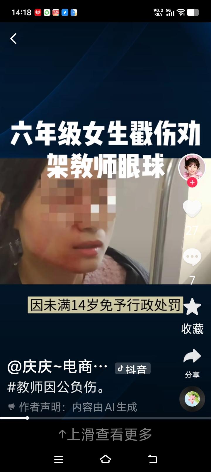 宋老师太冤了！瑞安宋老师的眼睛还要做第三次手术，虽然女生家长支付了医药费，但
