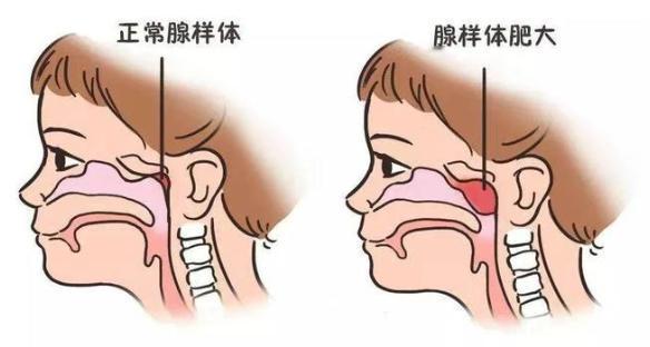 暑假到了，这是小儿耳鼻喉科最忙碌的日子，一大波腺样体将被收割我被问得最多的问题