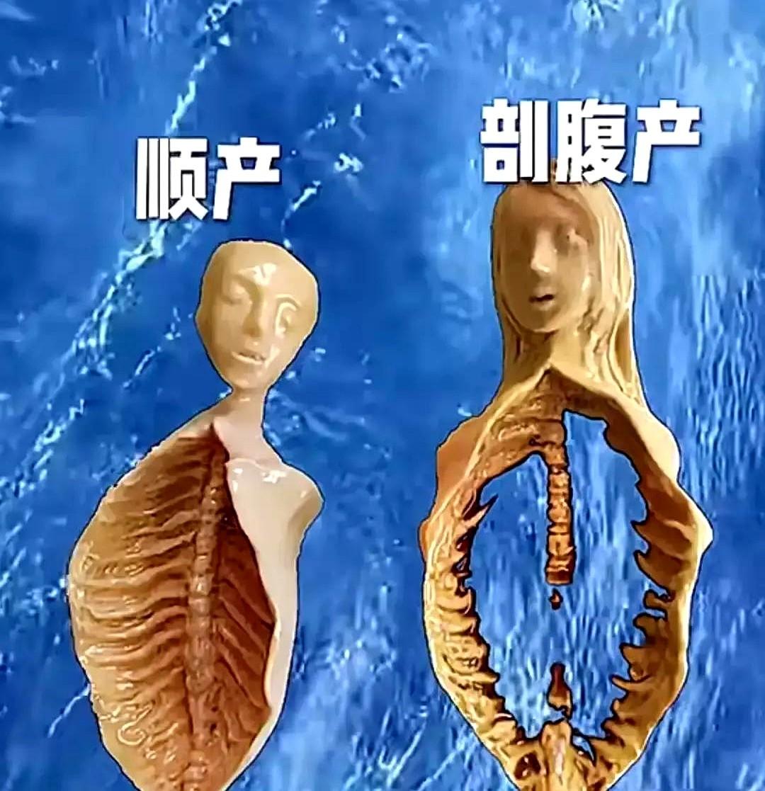 生了两个孩子我才想明白，剖腹产这事，省心的根本不是妈。那个男人就站在旁边，只觉