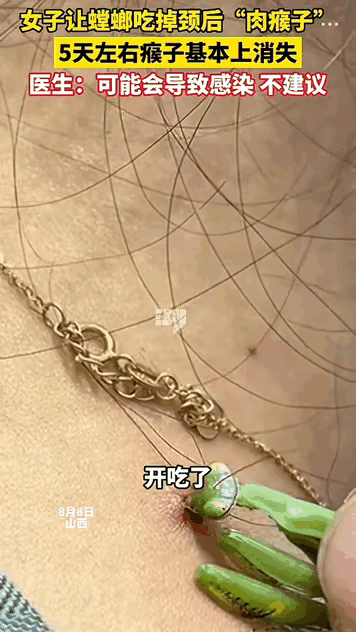 这绝对是狠人！ 山西一女子相信偏方，让螳螂吃掉自己后颈长得肉瘊子，虽然螳螂啃