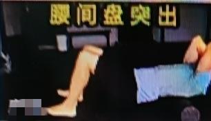 很多人以为久坐是腰间盘突出的头号元凶，其实不然。医生提醒，真正导致腰间盘突出的根