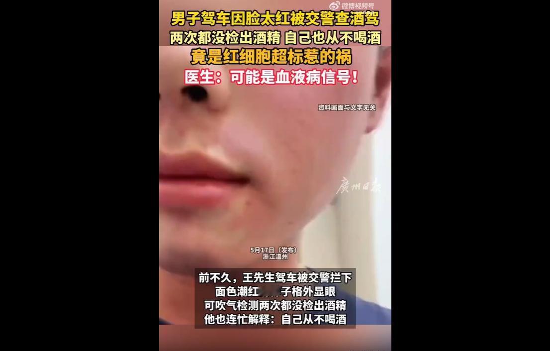 近日，浙江温州王先生驾车时因面色异常潮红、嘴唇发紫，被交警误以为是酒驾拦查。两
