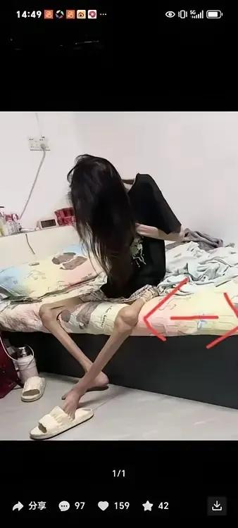 什么病？导致妙龄女子肌肉流失，骨瘦如柴？瘦骨头女孩肌肉疾病太瘦了抵抗力差