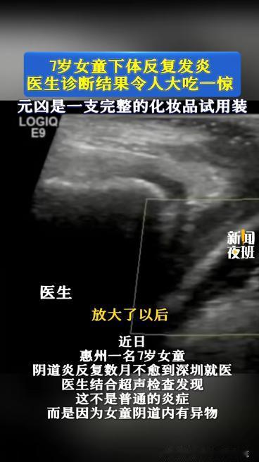 “万万没想到！”近日，广东，一7岁女孩阴道炎反反复复，家长试过什么办法都不见好，