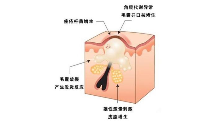 痤疮与毛囊炎有何区别?