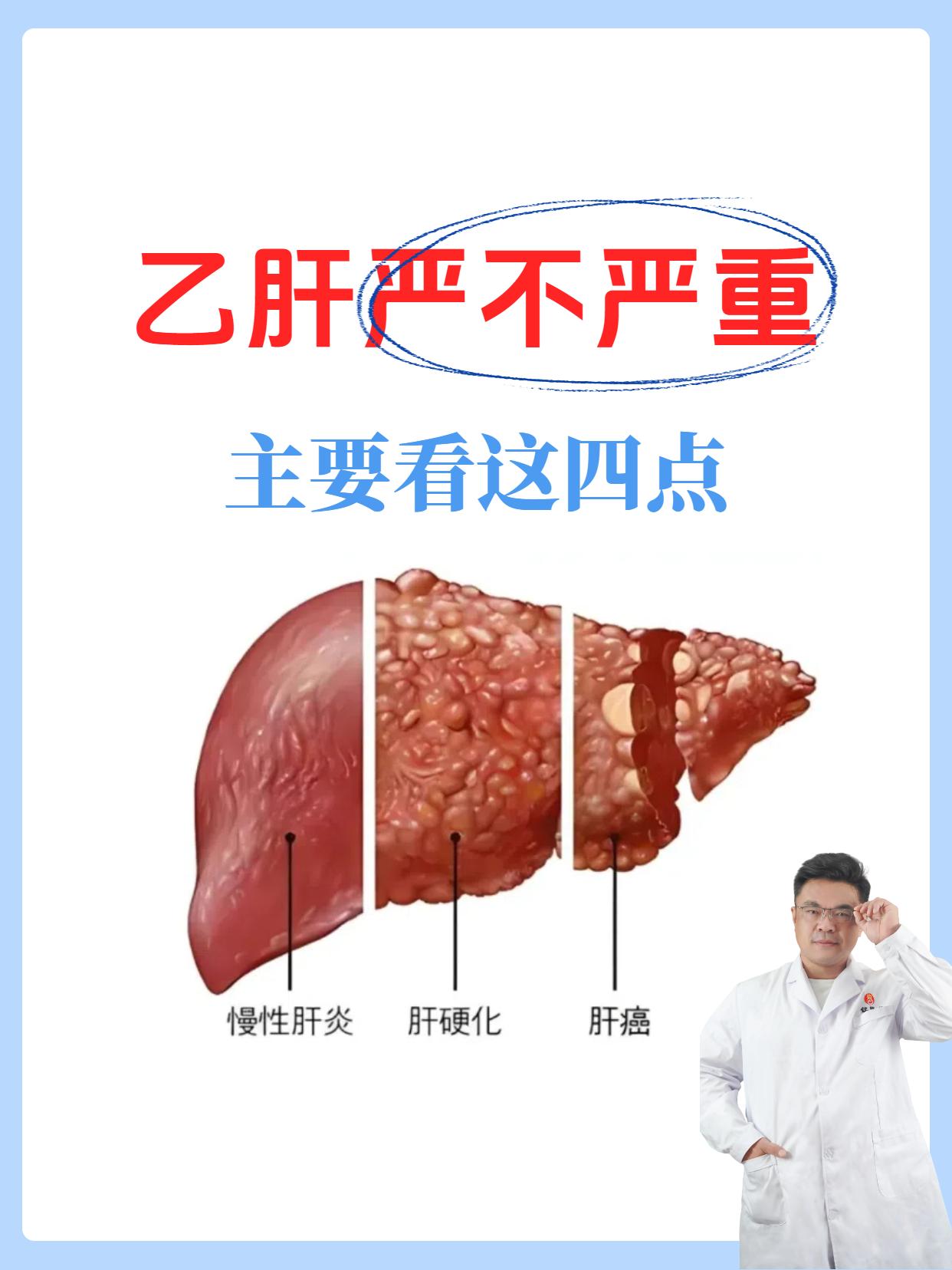 乙肝严不严重，主要看这四点。