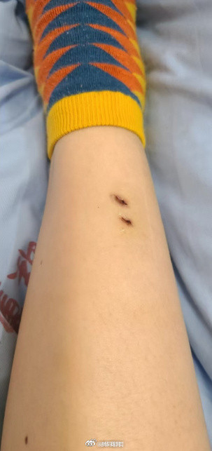 惊魂2年！辽宁女子被银环蛇咬伤后全身瘫痪式昏迷，至今洗脸都疼到崩溃！