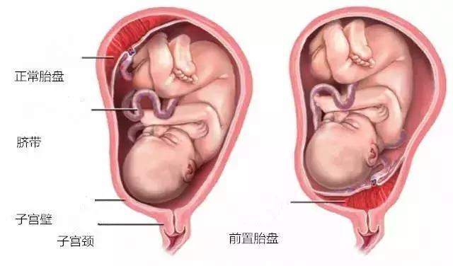 胎盘前壁和胎盘前置不是一个意思, 两者区别还很大