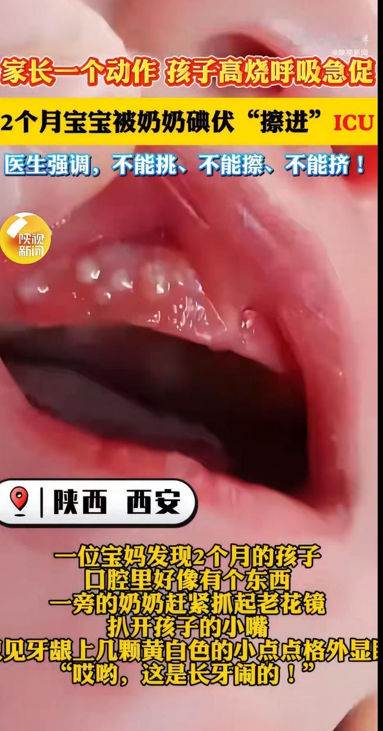 近日，一则“奶奶用碘伏擦拭2个月宝宝马牙引发高烧”的新闻令人心惊。据报道，奶奶发