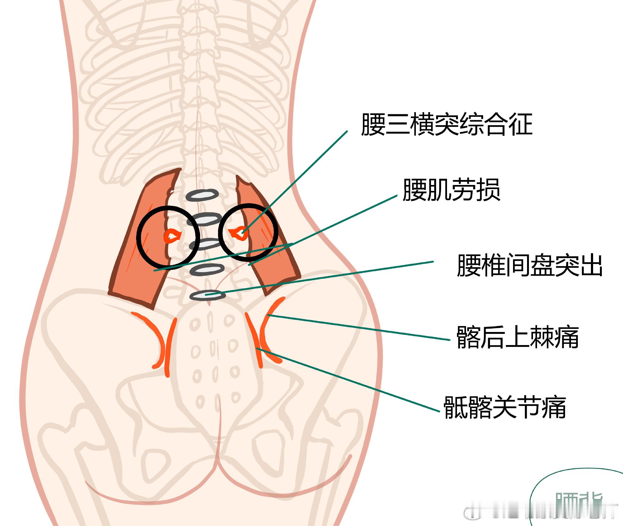 腰腿臀部疼痛的常见原因腰疼腿疼一直是康复师们在线下门诊最常见的问题，再把这份总