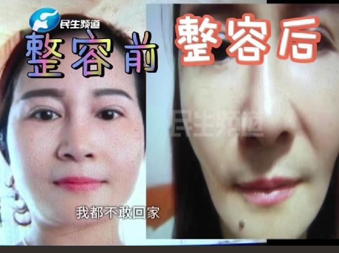 女子整容前，脸蛋圆润，肤白貌美，为了更漂亮，整容让下巴变尖，结果整张脸都整的不自
