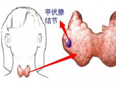 单发性甲状腺结节比多发性危害更大