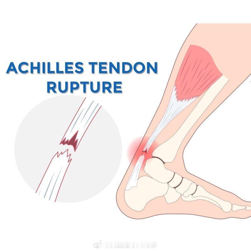 埃基蒂克跟腿断裂埃基蒂克赛季报销埃基蒂克无缘世界杯利物浦官方确认，法国前锋埃