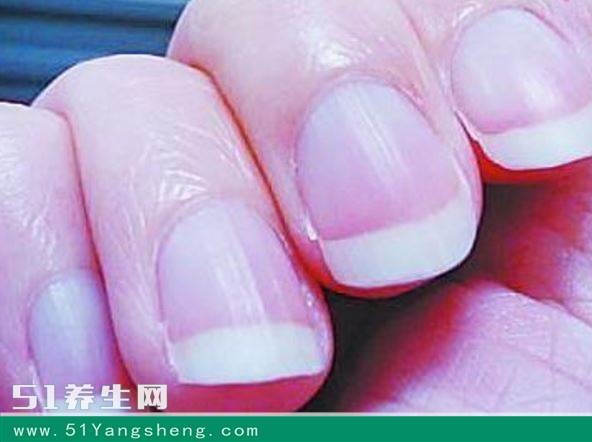 指甲有竖纹是什么原因? 如何消除指甲上竖纹