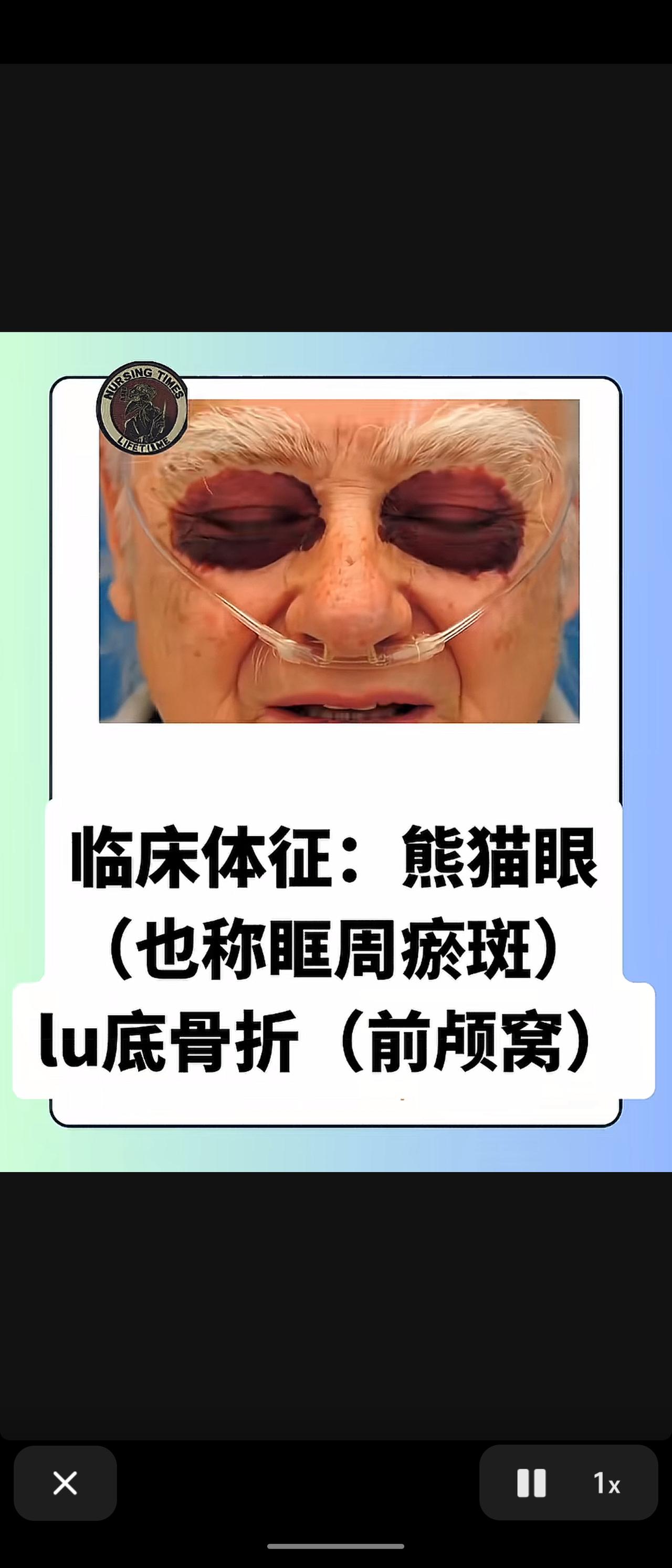 “熊猫肌”（眶周瘀斑）是颅底骨折，尤其是前颅窝骨折的典型临床体征。因颅底骨折导致