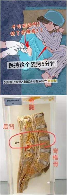 麻醉！[无奈吐舌]男人看看，女人不容易！上图是剖腹产术前，腰麻示意图，孕妇弯腰