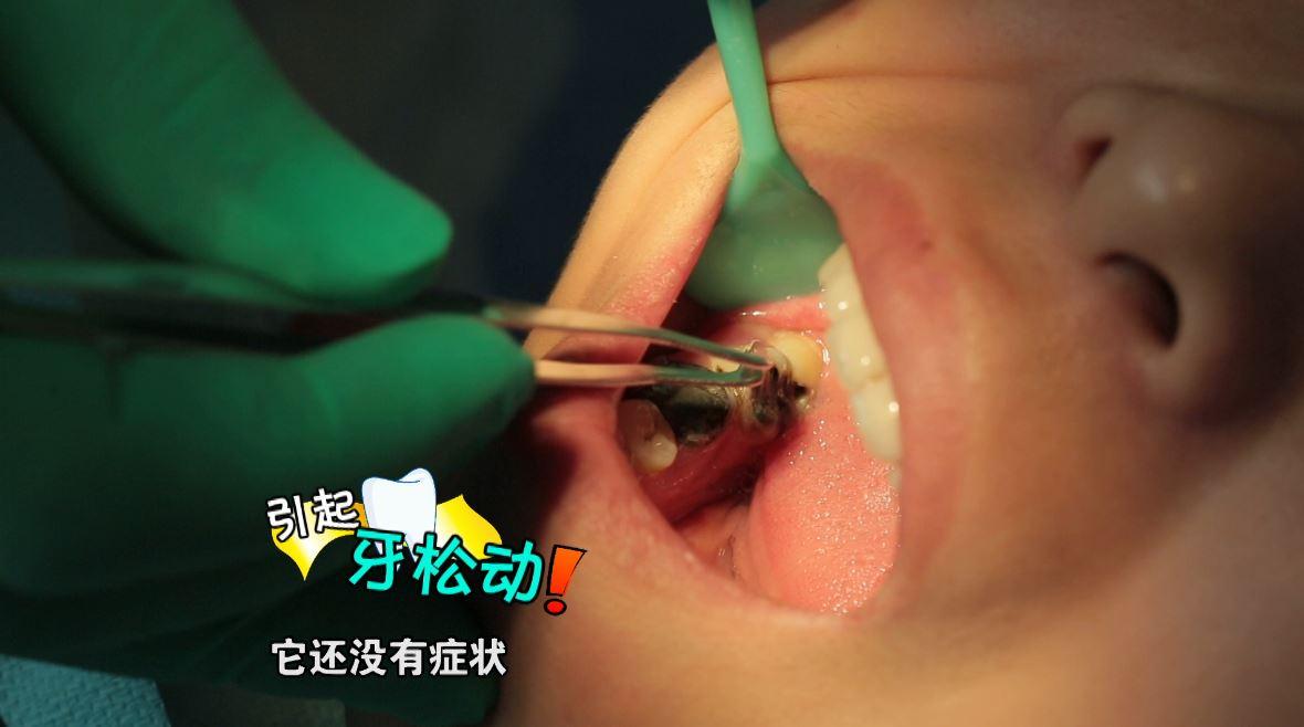 江湖牙医无痛拔牙到底是真是假?