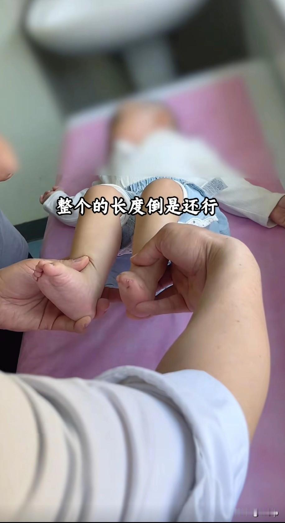 4月大的男童先天性少了半个脚掌医生说，不影响走路，不能为了手术而手术，这位医生