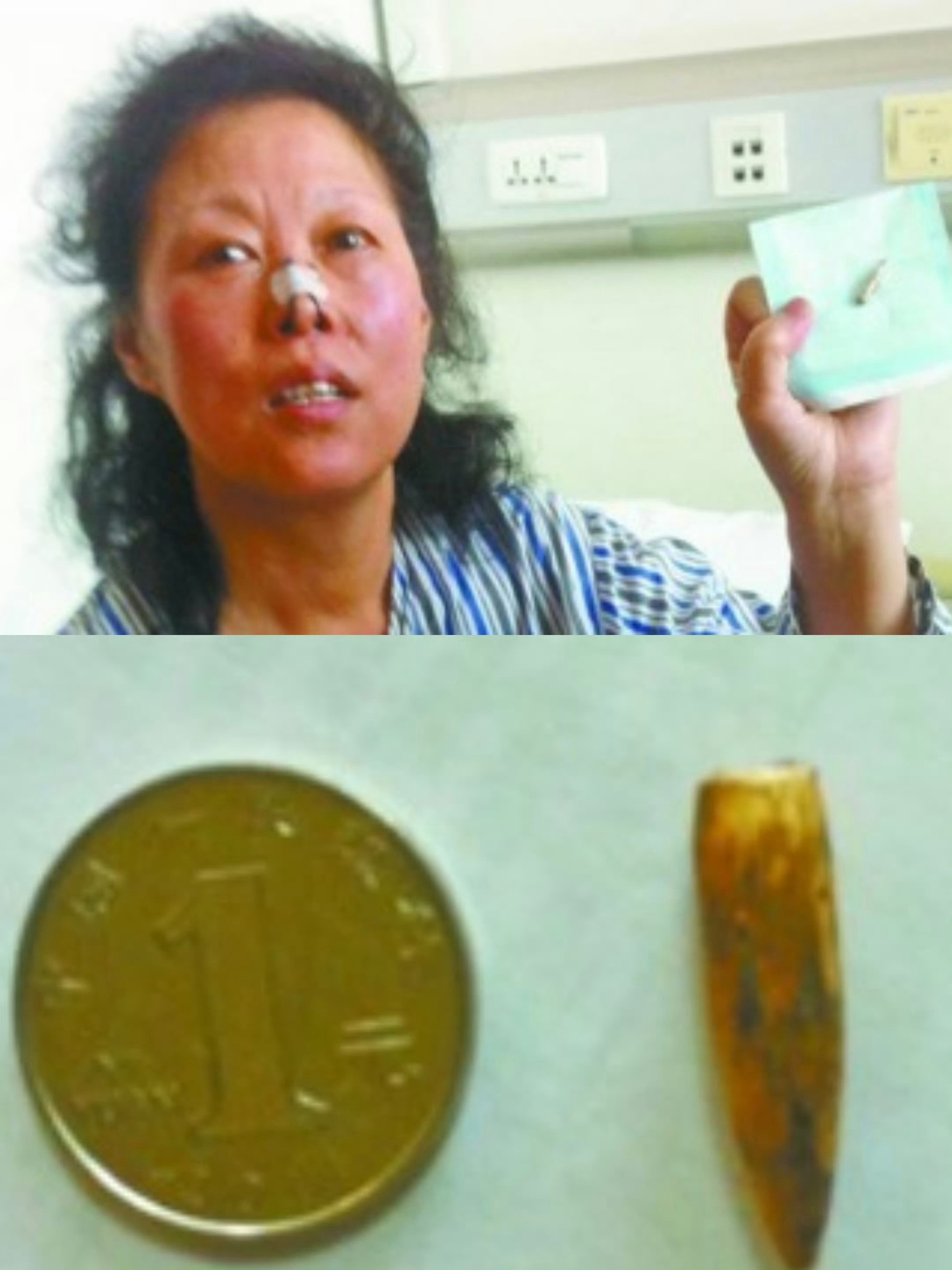 女子咳嗽4个多月元凶竟是一颗牙齿异物吸入呼吸道、支气管4个月！这条新闻跟图2有得