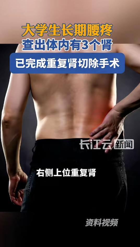 陕西，一小伙身体右侧偶尔腰痛、腹痛，在学校检查时，发现自己体内有3个肾，并且多出