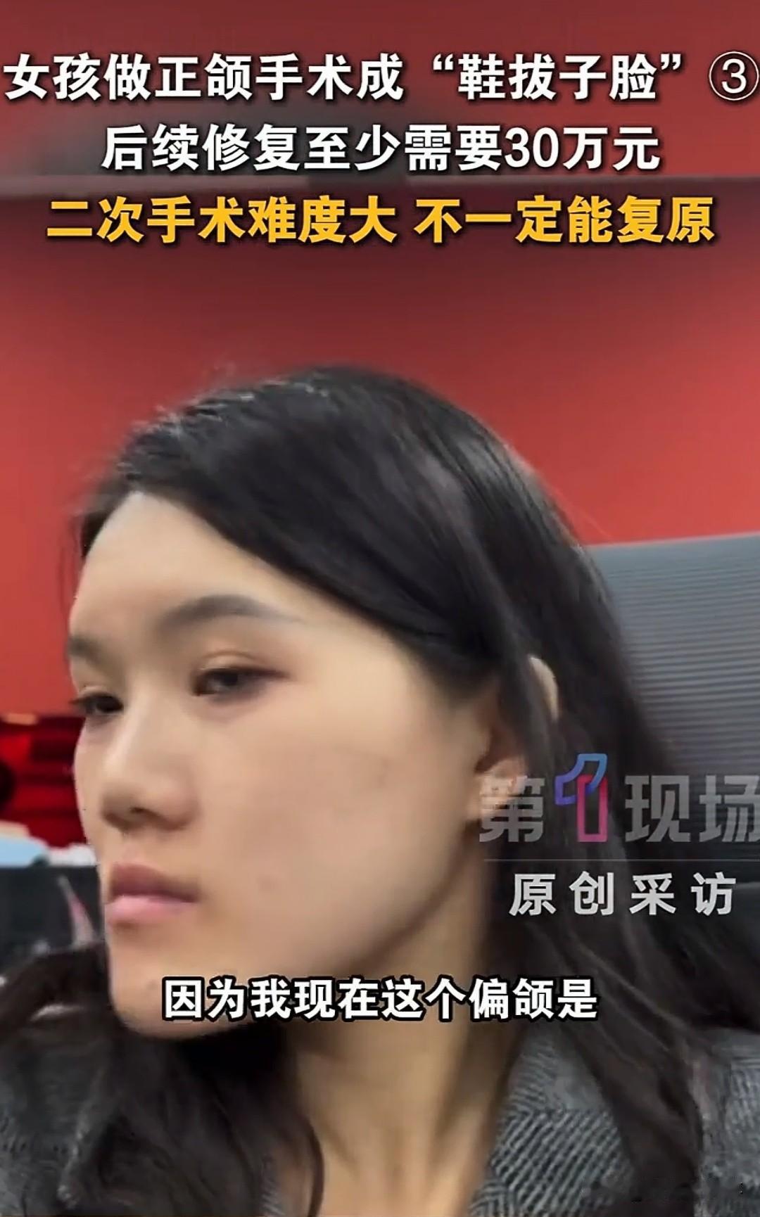 太离谱了！24岁女孩小雨做正颌手术，方案写的是“下颌回缩2毫米”。可术后CT显示
