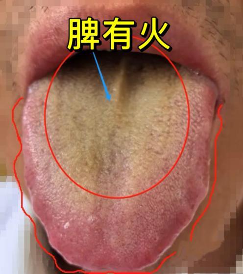 大家好，我是中医陈大夫！生活里不少人总被牙龈肿痛、口腔溃疡缠上，还伴着喉咙疼、好