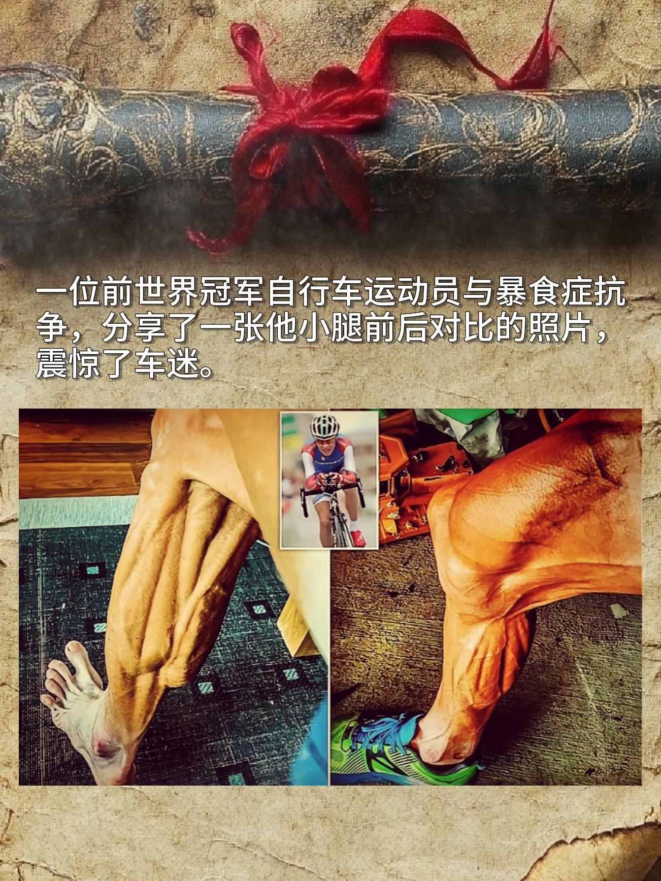 一位前世界冠军自行车运动员与暴食症抗争，分享了一张他小腿前后对比的照片...