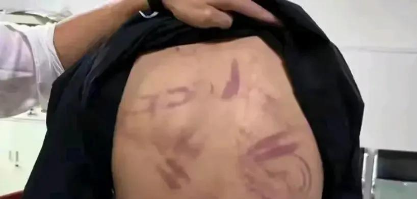 保安动用私刑殴打两个小青年，通告也来了，有5名保安拘留，有1名保安刑拘！最近有