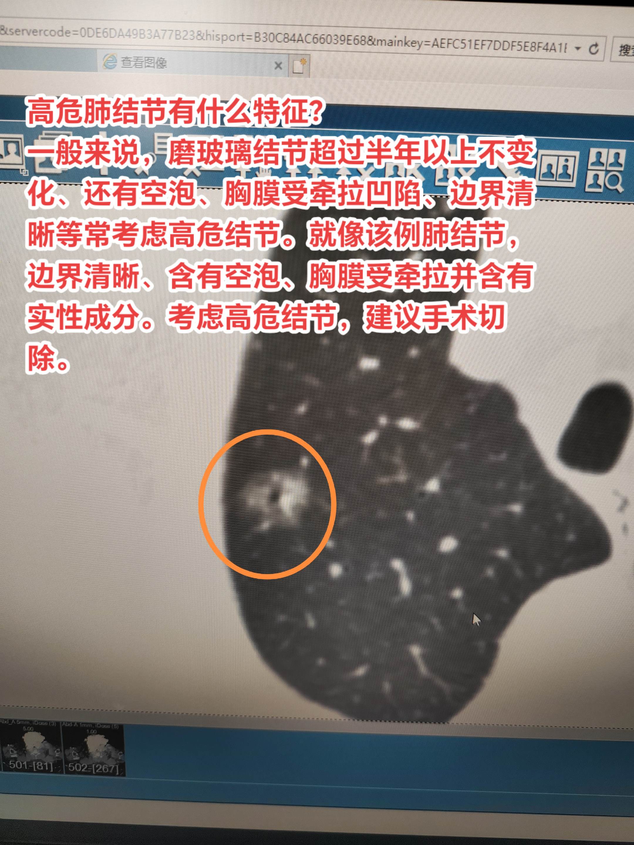 高危肺结节有什么特征？一般来说，磨玻璃结节超过半年以上不变化、还有空泡...