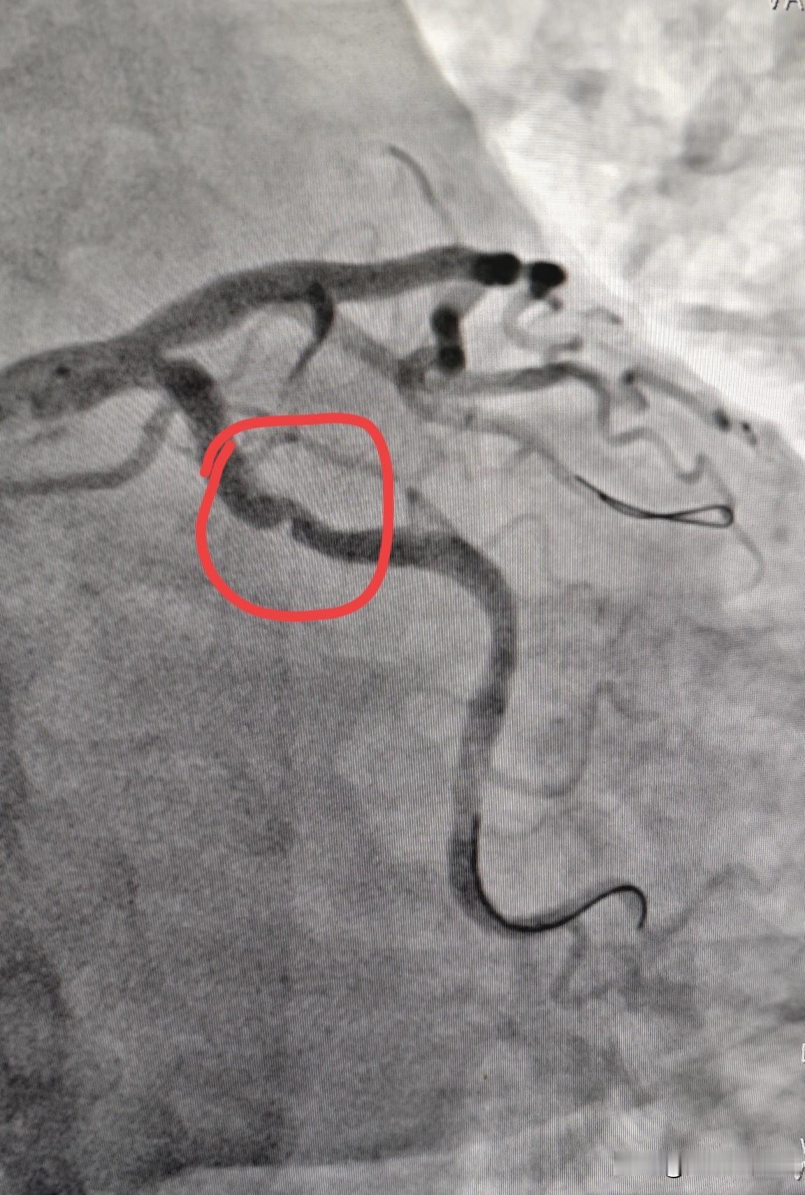 冠状动脉痉挛什么样？快来直观看一下冠状动脉痉挛。这是一个做冠脉支架的患者，在导