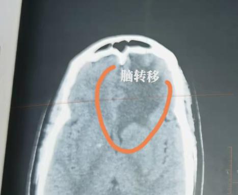 很多朋友都觉得，头痛、头晕就是小毛病，睡一觉、吃点止痛药就过去了，但对肺癌患者来