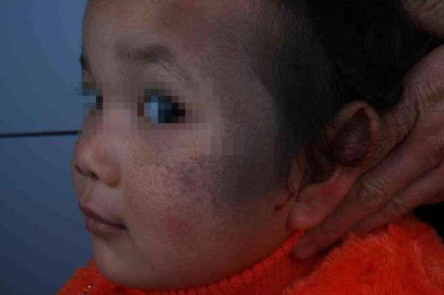 父母因孩子胎记而离婚, 准妈妈孕期多注意这几点, 宝宝健康无胎记