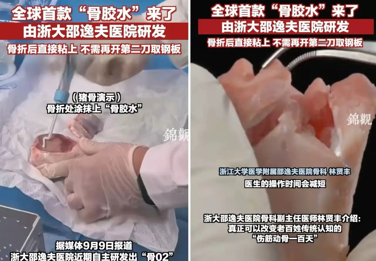 浙大邵逸夫医院“骨胶水”：革新骨折治疗的重磅突破一、技术突破，开启骨折治疗新篇