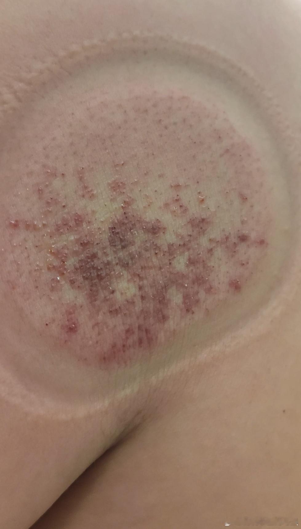 有时候中药效果快的连我都感觉神奇一朋友湿疹一周，外用药无效开了三副中药吃了一副不