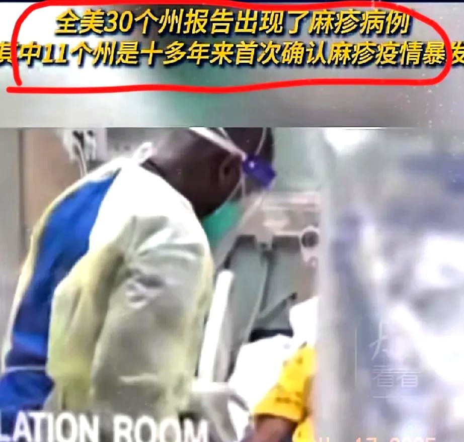 美国麻疹大爆发，家长们长点心吧！美国现在简直乱套了！麻疹