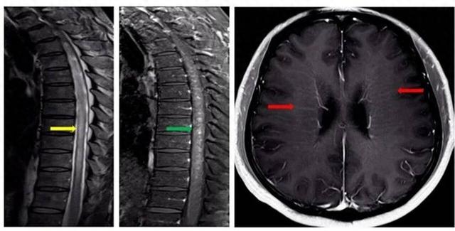 两腿发沉、胳膊麻木、排尿困难……中年教师确诊罕见疾病