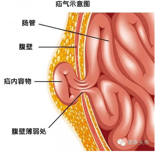 宝宝疝气轻松恢复, 多亏家长用了“它”