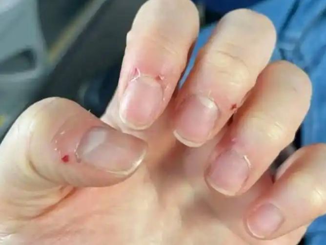 悲剧还是发生了！近日，浙江杭州，一男子见手指长了个“倒刺”，就顺手拔掉了，结果第