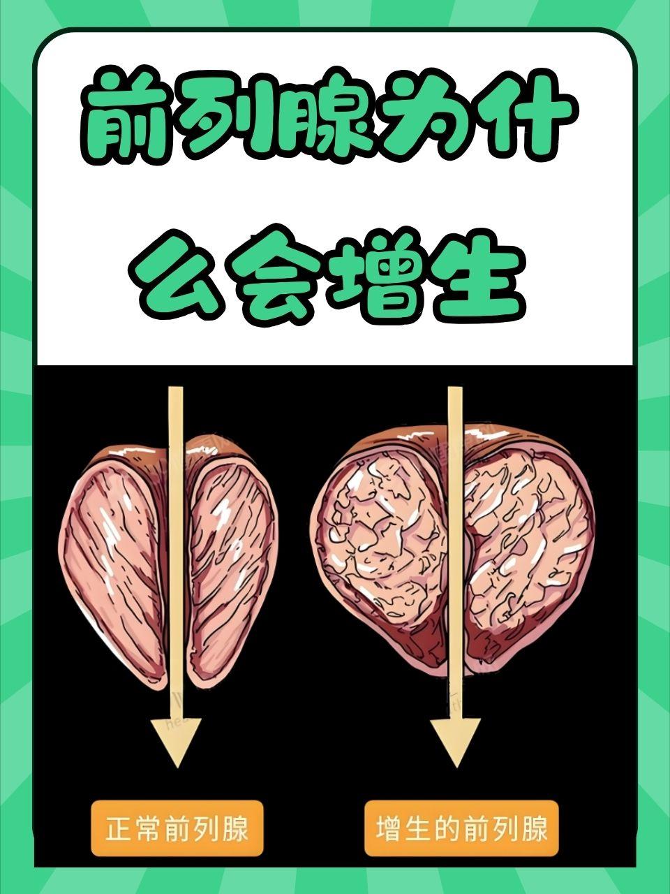 前列腺增生是如何形成的?对于前列腺增生很多朋友并不陌生,因为增生的前