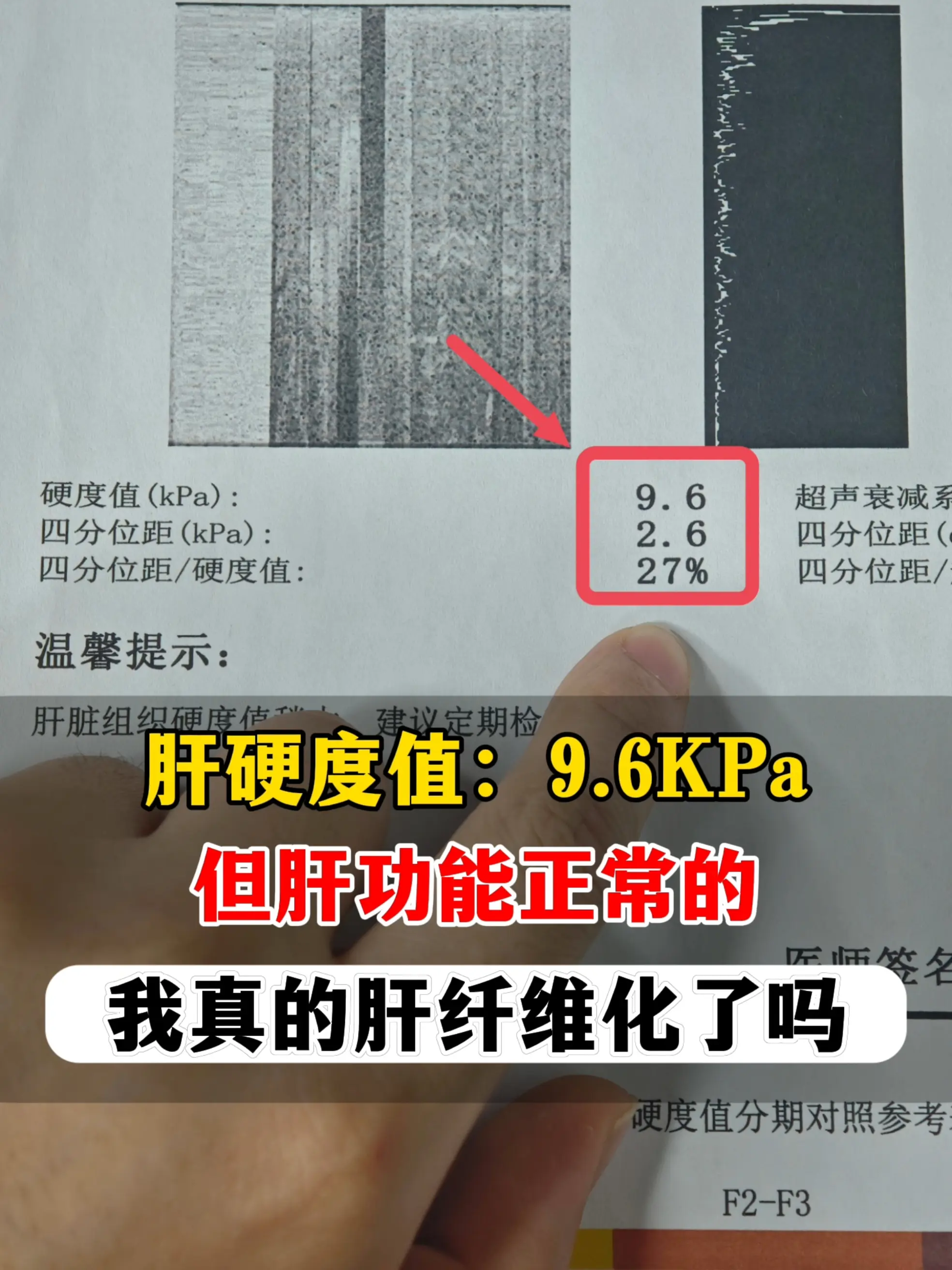 教授，我关注您 1 年多了，一定要解答我这个问题啊！我查出乙肝 10 ...