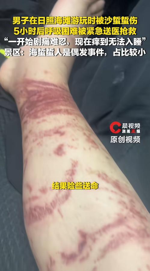 “瞧这事儿闹的！”近日，山东日照，一外地游客到海边景区游玩，结果不小心被海蜇给蜇