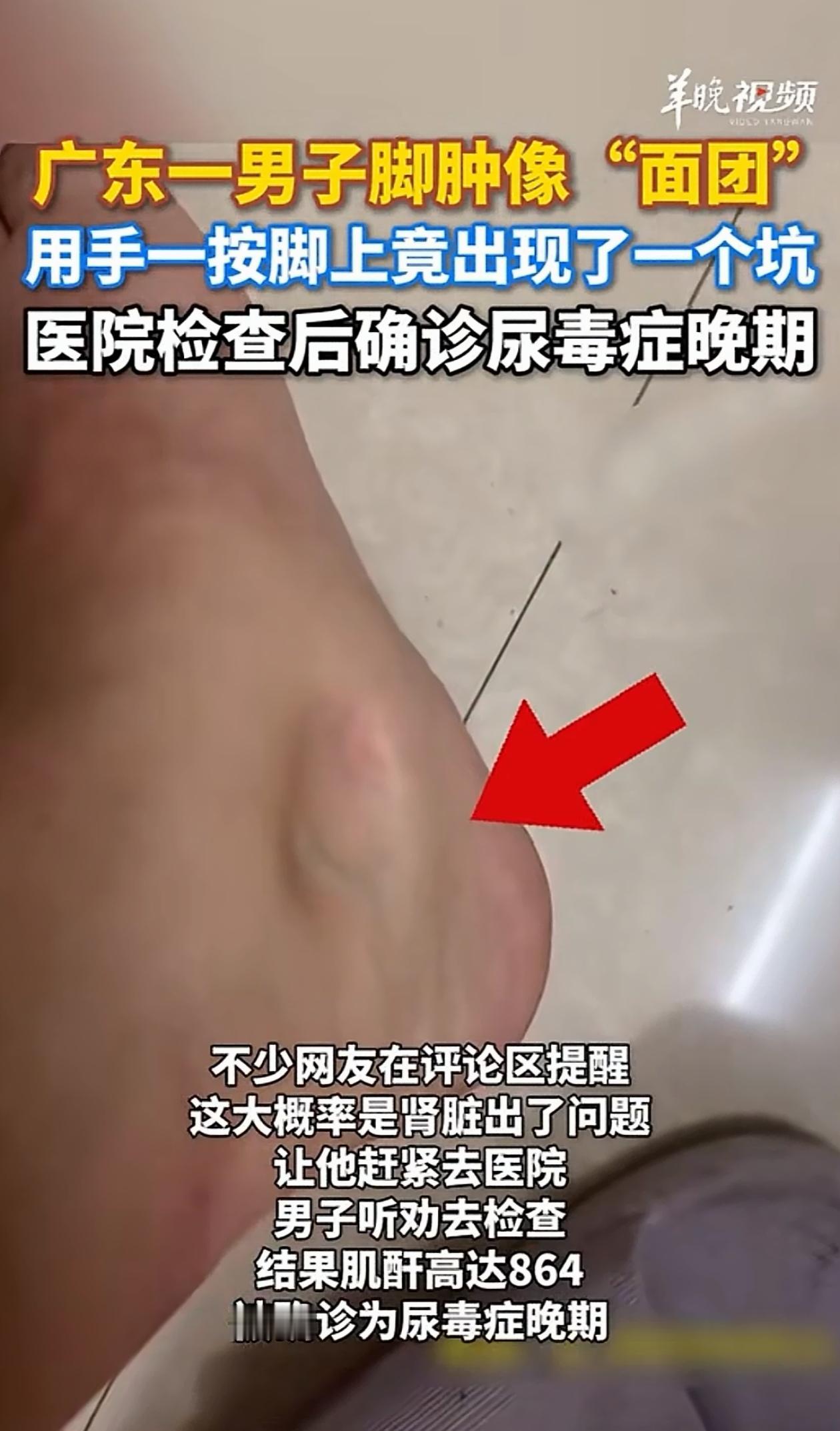 破防了！广东，男子回家后，发现自己脚肿的厉害，他好奇按了一下，发现脚上很快就出现