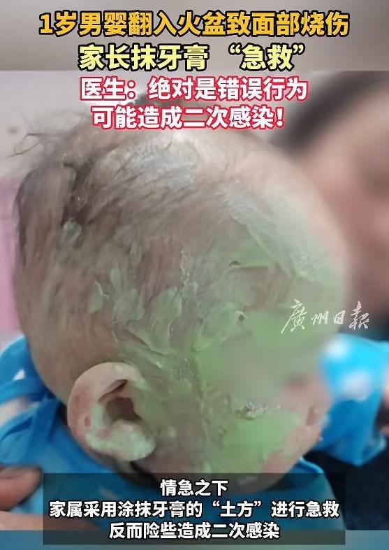 江西南昌一名1岁1个月的宝宝，不慎跌入火盆导致面部烧伤。让人揪心的是，家长情急之