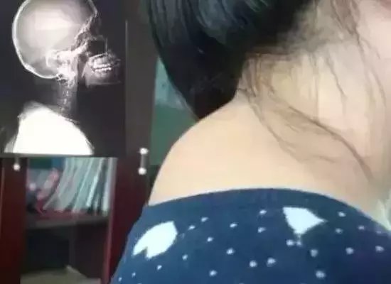 刮痧+艾灸, 化掉你身上的夺命大包!
