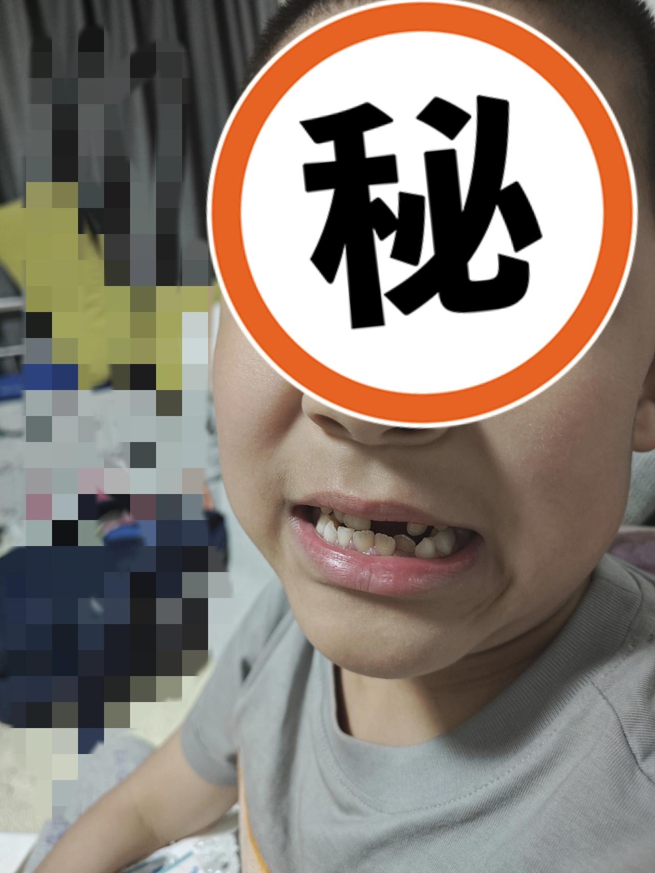 孩子掉牙咋变难了？小儿从去年开始换牙，神奇的是，外面的牙齿还没掉，新牙已