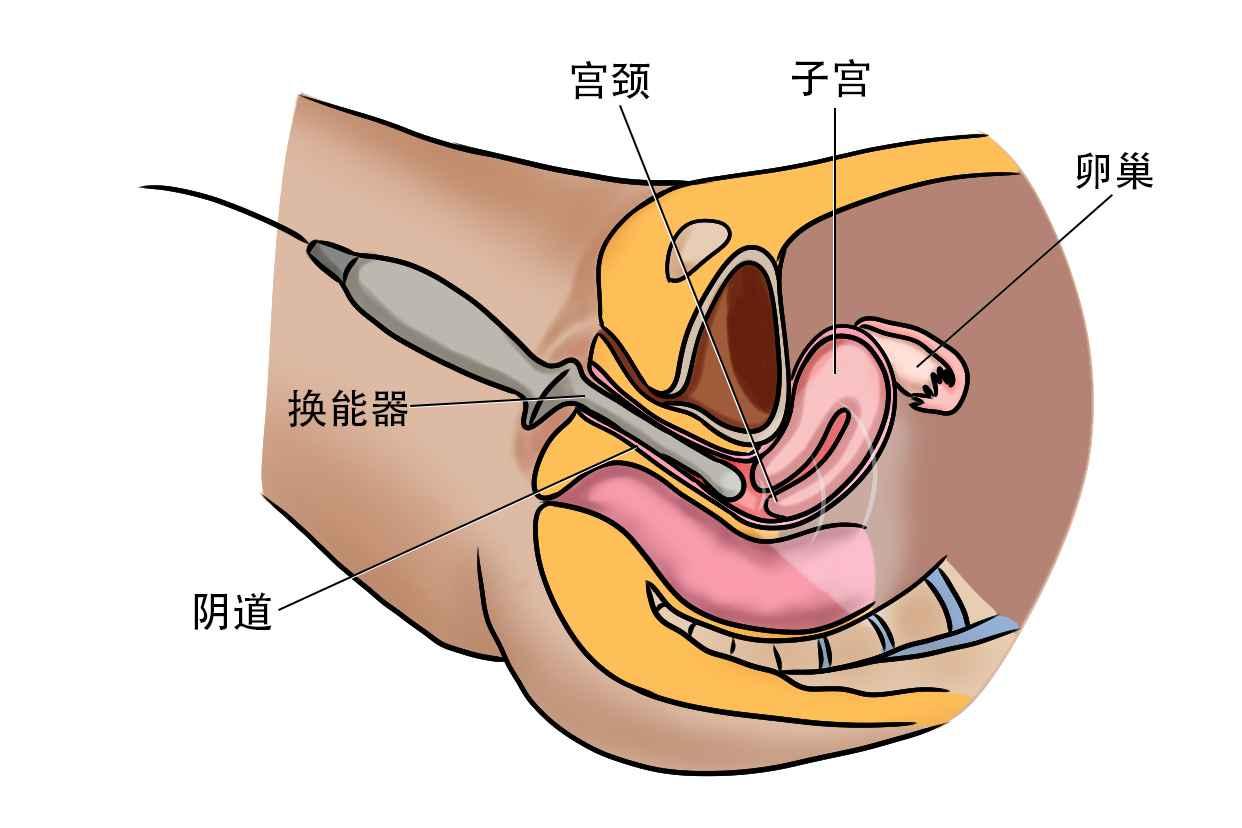 在妇科排队做阴超，结果发现前面那个女的是感染了真菌，有炎症，我就在她后面做，那个