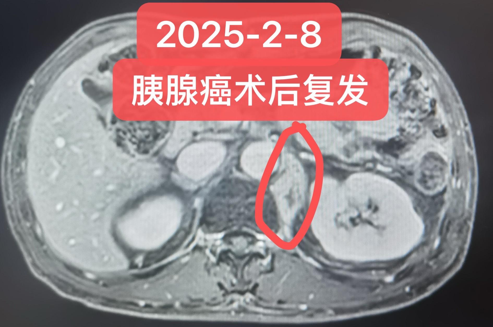 一例胰腺癌术后复发转移的挽救治疗。患者男，61岁，胰腺癌术后7月出现腹...